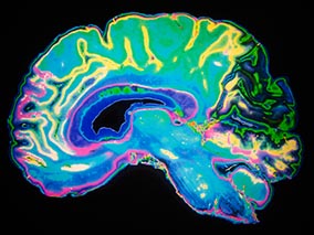 New hypofractionated proton therapy for elderly patients with newly diagnosed glioblastoma