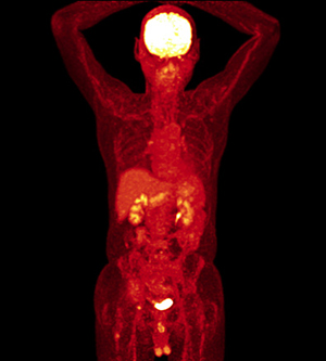 First Results Of Total Body Dynamic Pet Scan The Asco Post