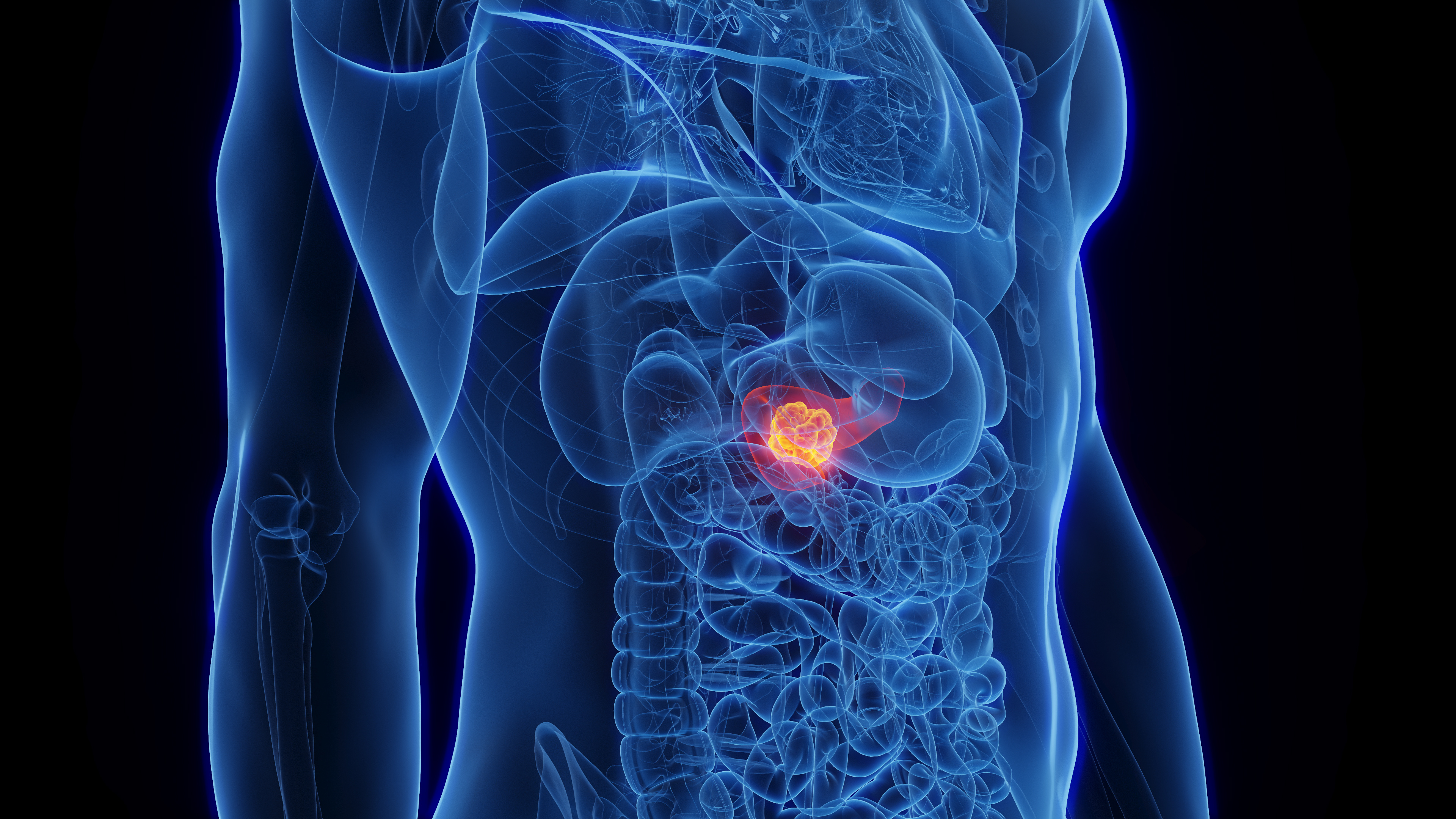 Rising Incidence of Pancreatic Cancer in Young Adults: Key Findings and Implications