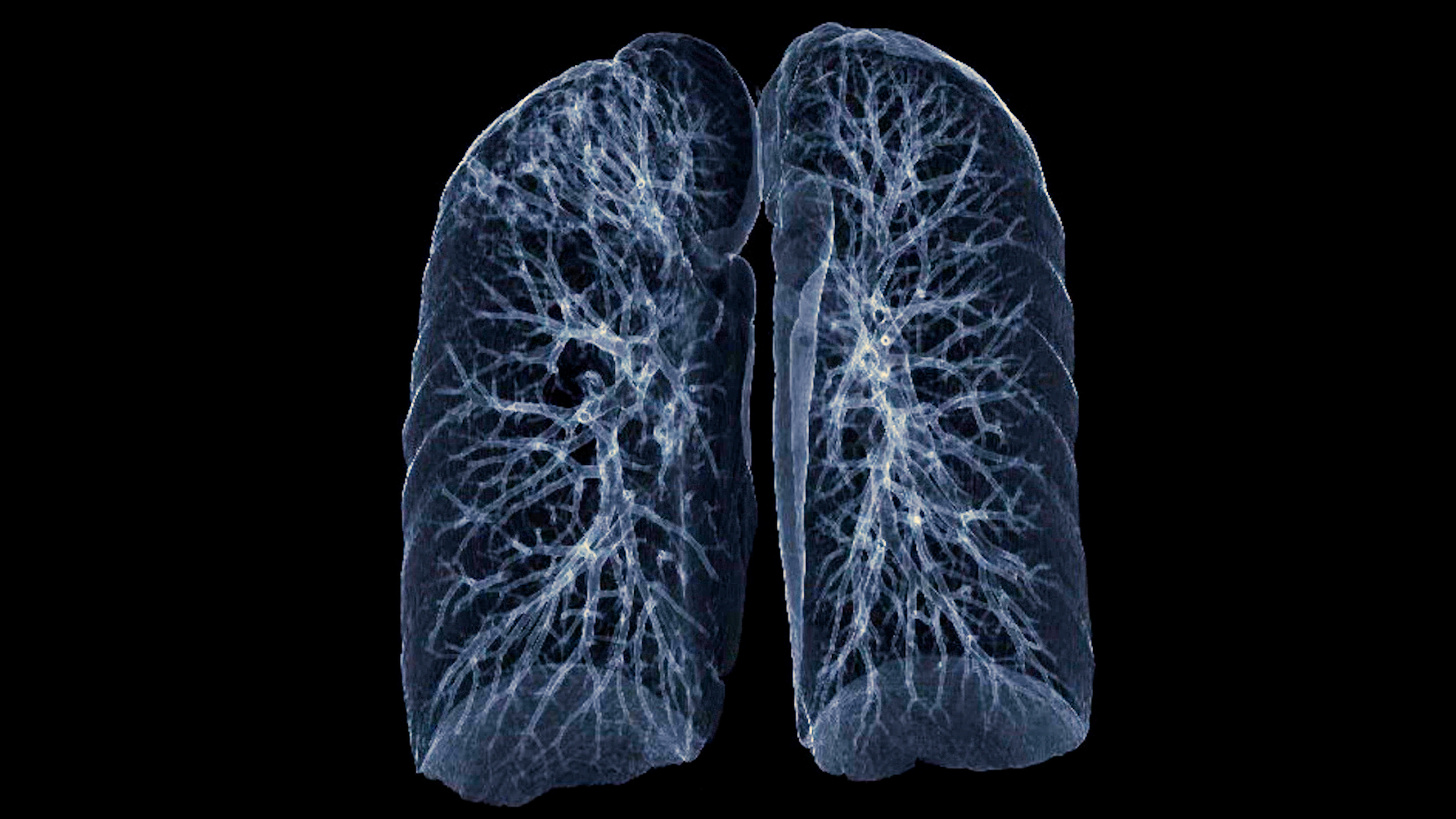 Should low-dose CT scans be recommended for people at low risk for lung cancer?