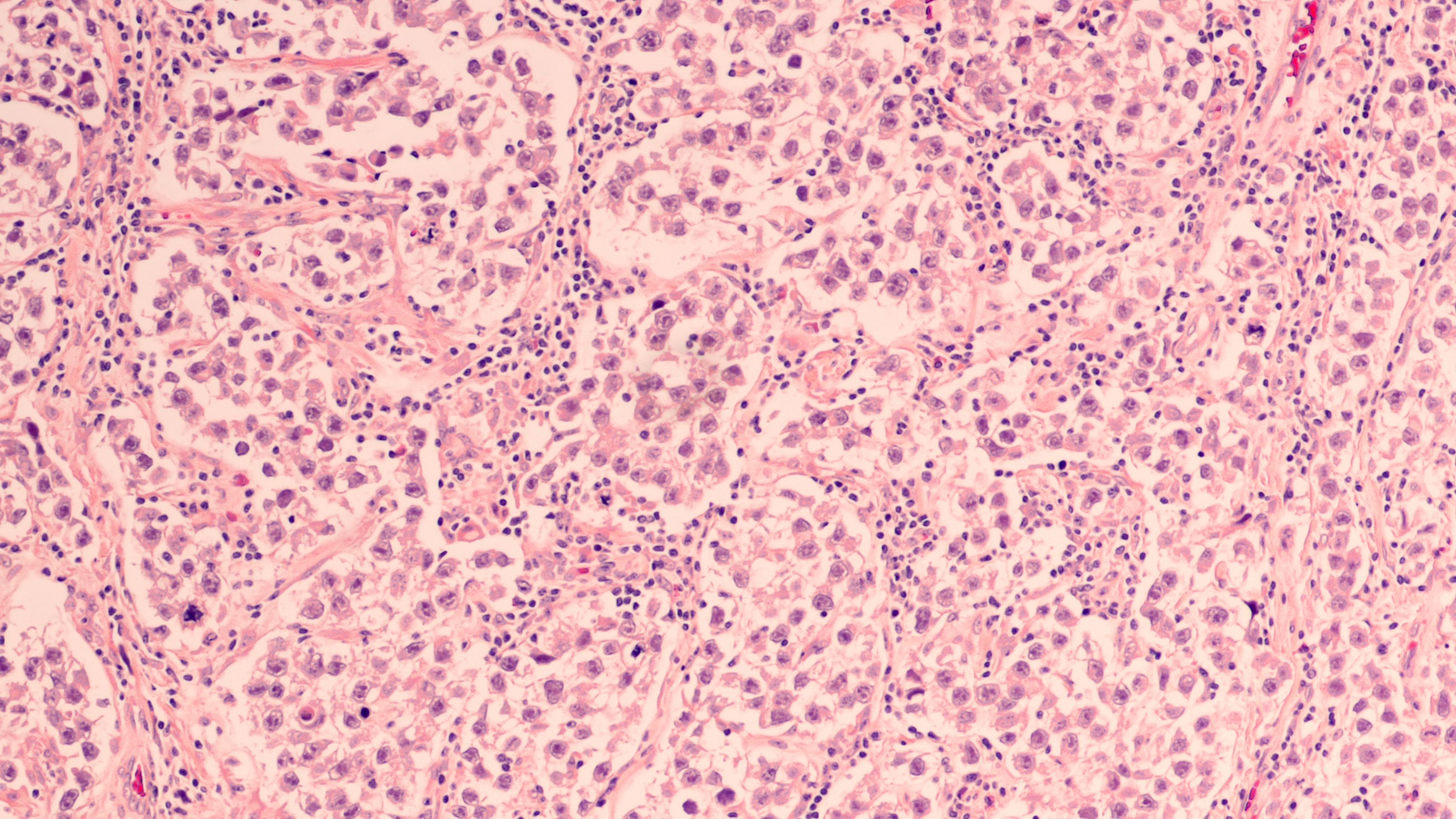 Triplet as Initial Salvage Treatment for Advanced Germ Cell Tumors Long ...