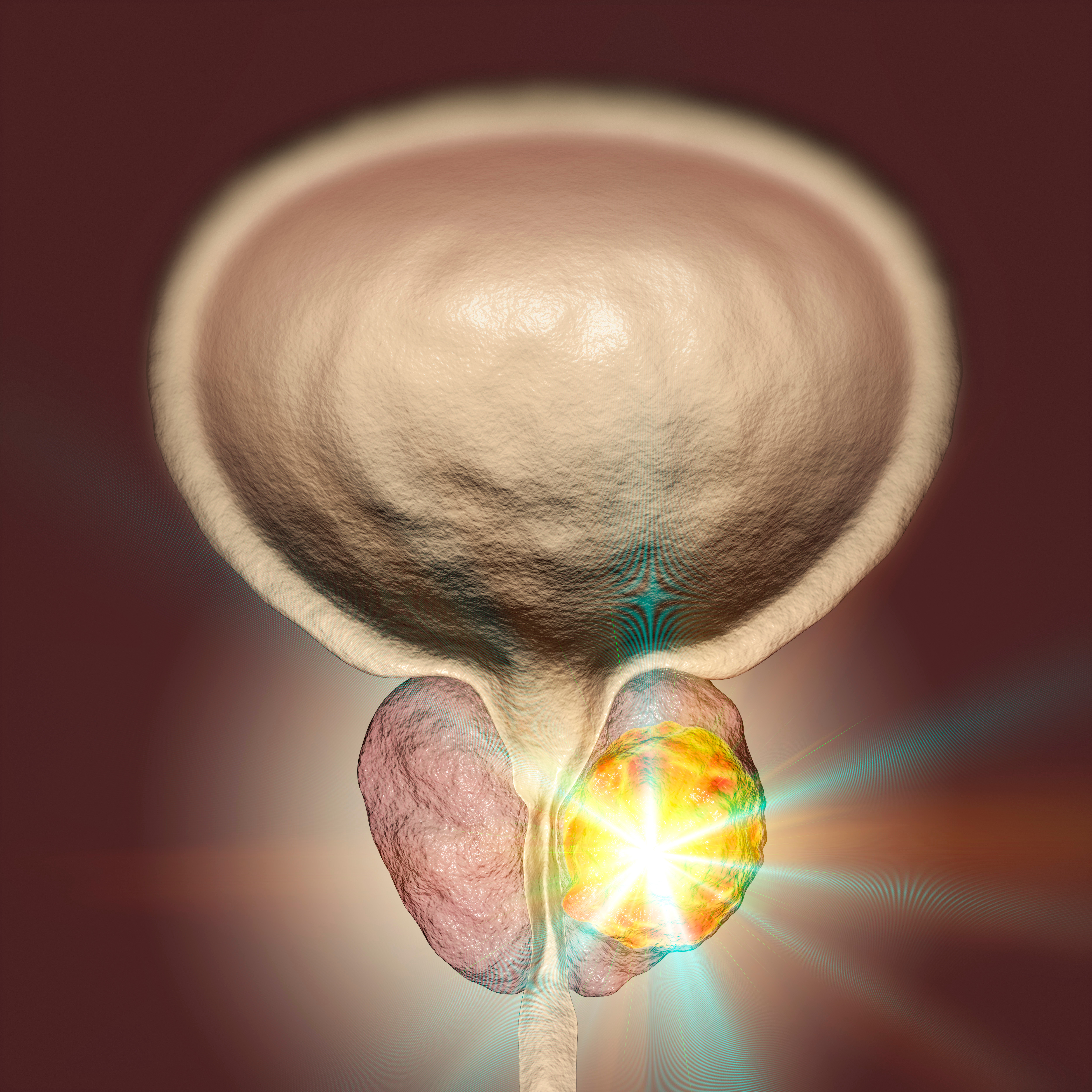 Olaparib May Be Effective Without Hormone Therapy in Some Men With ...
