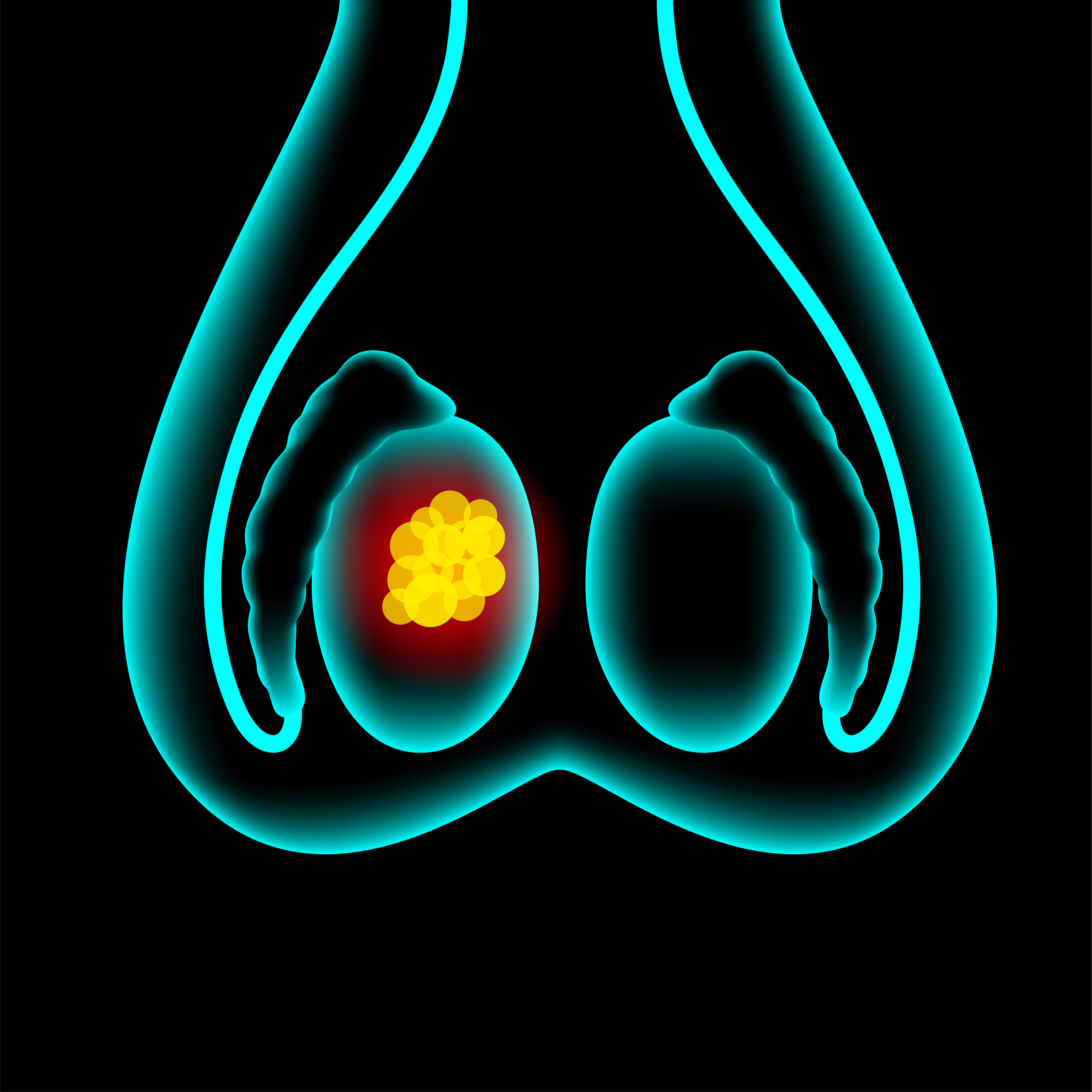 miR-371a-3p Predicts Recurrence in Stage I Testicular Cancer - News Directory 3