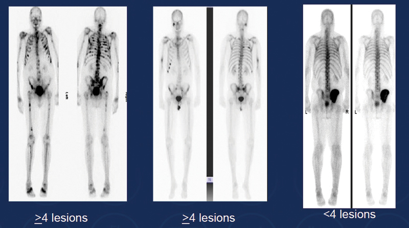 high volume prostate cancer definition)