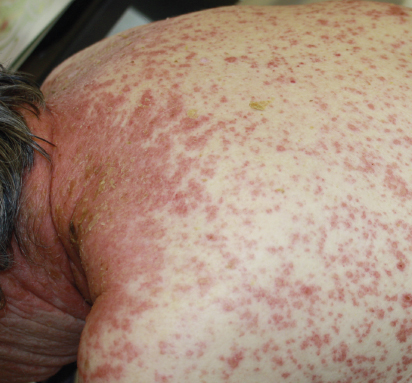 Keytruda Skin Rash